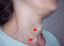 TRIỆU CHỨNG CỦA U TUYẾN GIÁP