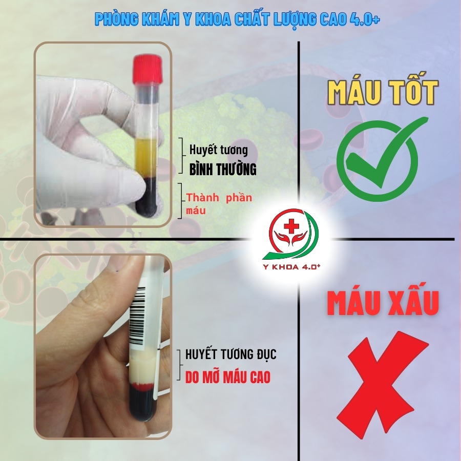 Lý do tại sao nên xét nghiệm mỡ máu định kỳ